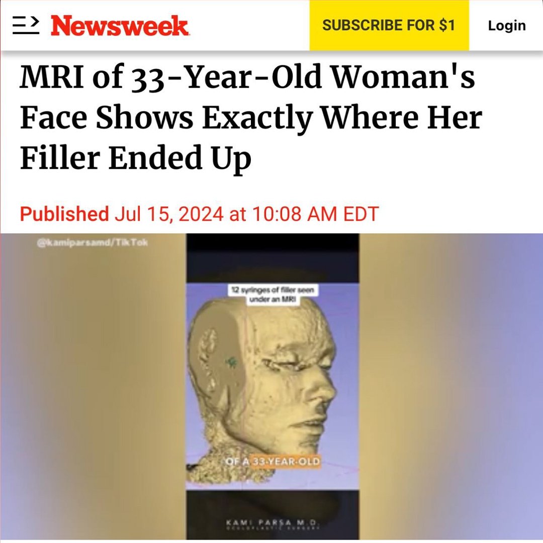 Newsweek article headline about MRI of a 33-year-old woman's face showing dermal filler distribution with 3D scan image. Published on July 15, 2024.