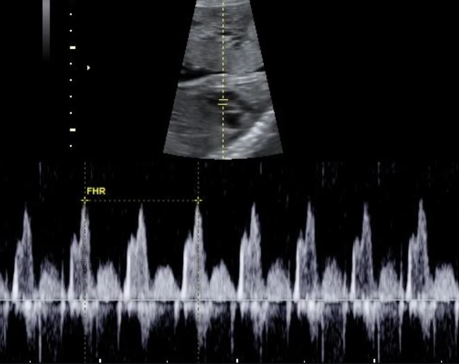 Ultrasound image displaying heart function with Doppler flow pattern.
