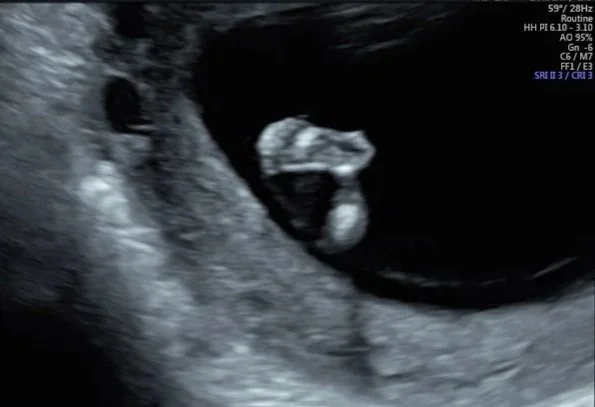 Ultrasound image showing a developing fetus in the womb.