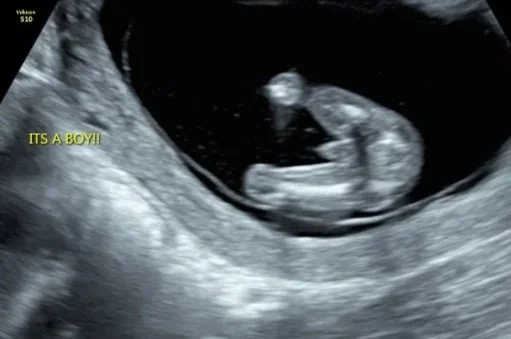 Ultrasound image of a developing fetus with the text "IT'S A BOY!!"