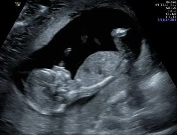 Ultrasound image of a fetus inside the womb.