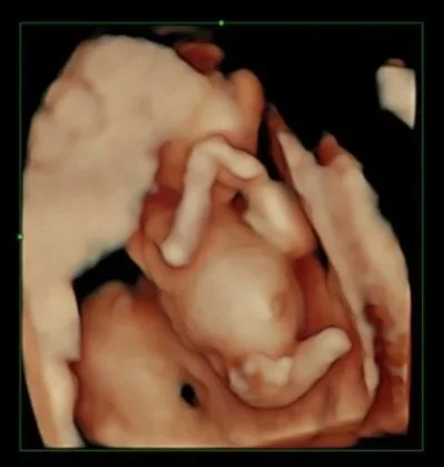 Ultrasound image of a developing fetus in the womb.