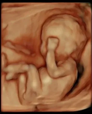 Ultrasound image of a developing fetus inside the womb.