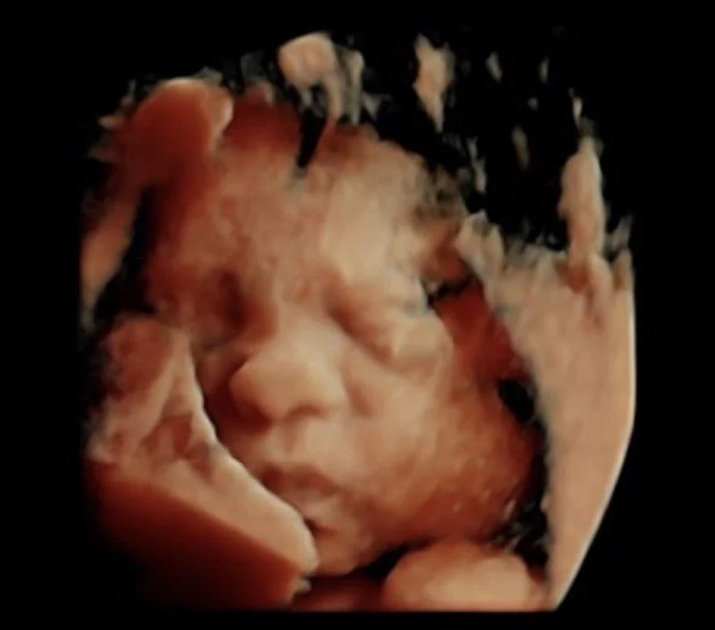 3D ultrasound image of a sleeping baby in the womb.
