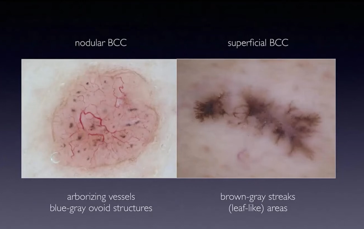 Dermoscopy of Basal Cell Carcinoma (BCC)