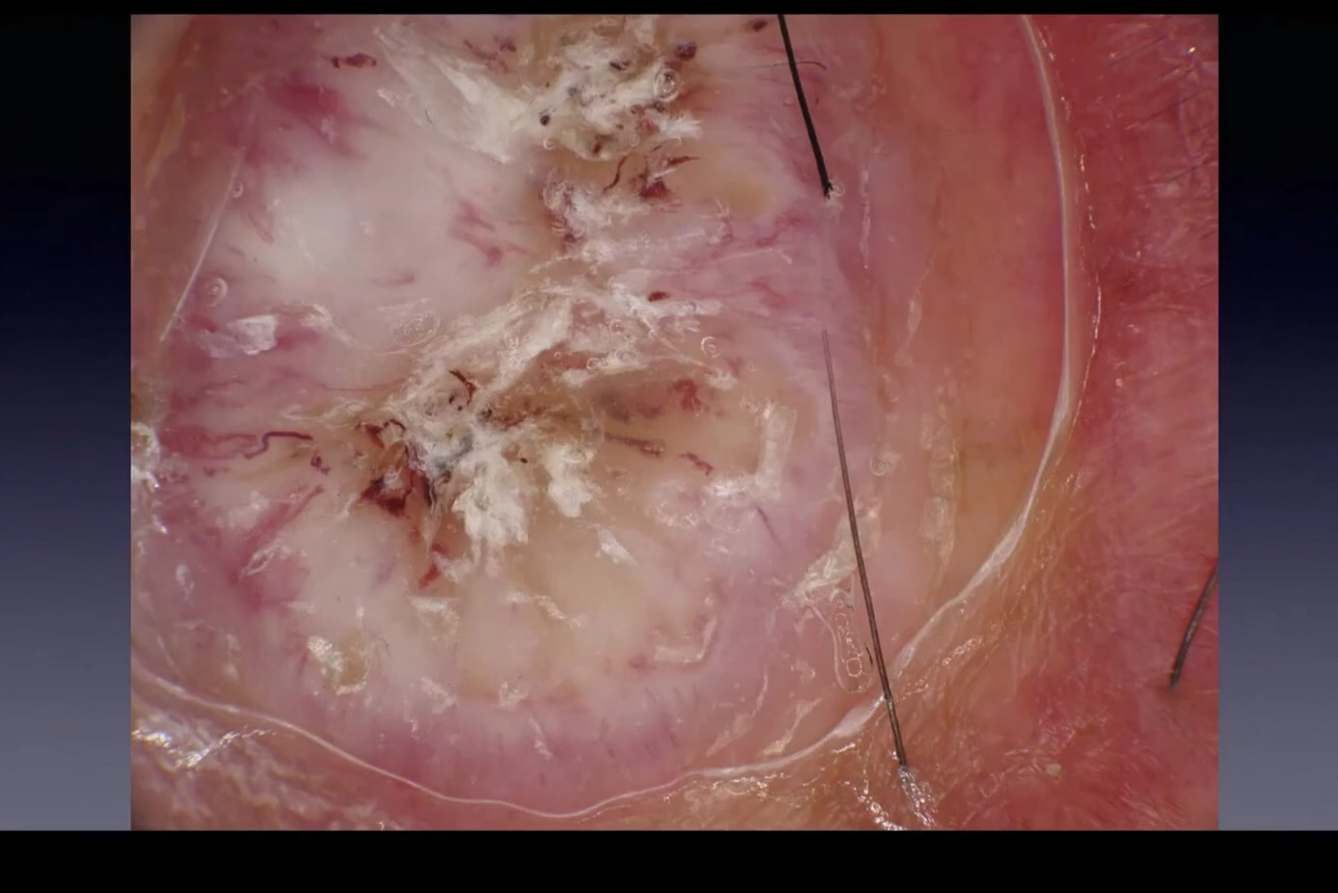 Dermoscopy of Squamous Cell Carcinoma (SCC)