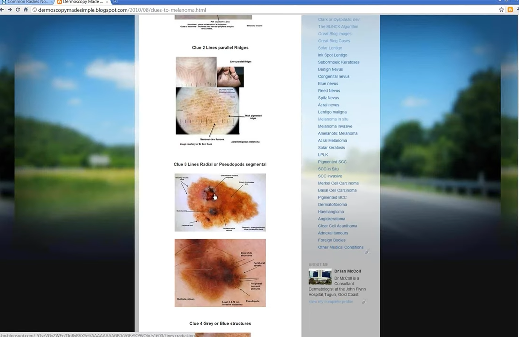 Dermoscopy of Melanoma