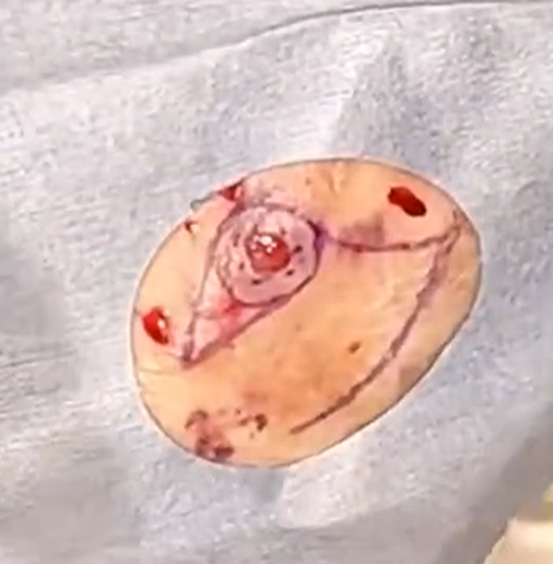 Close-up of a surgical wound on a person's skin showing an infected area with redness and swelling.