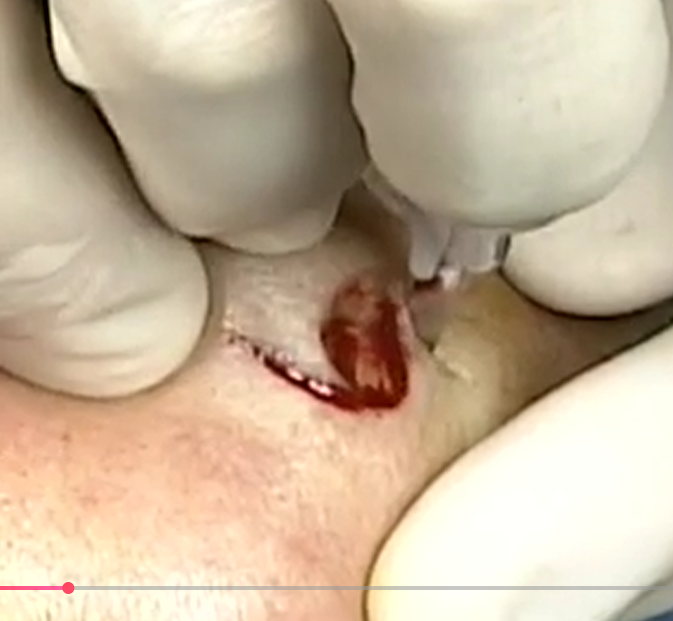 Close-up of a person receiving a dental check-up or treatment, with gloves on and dental tools visible.
