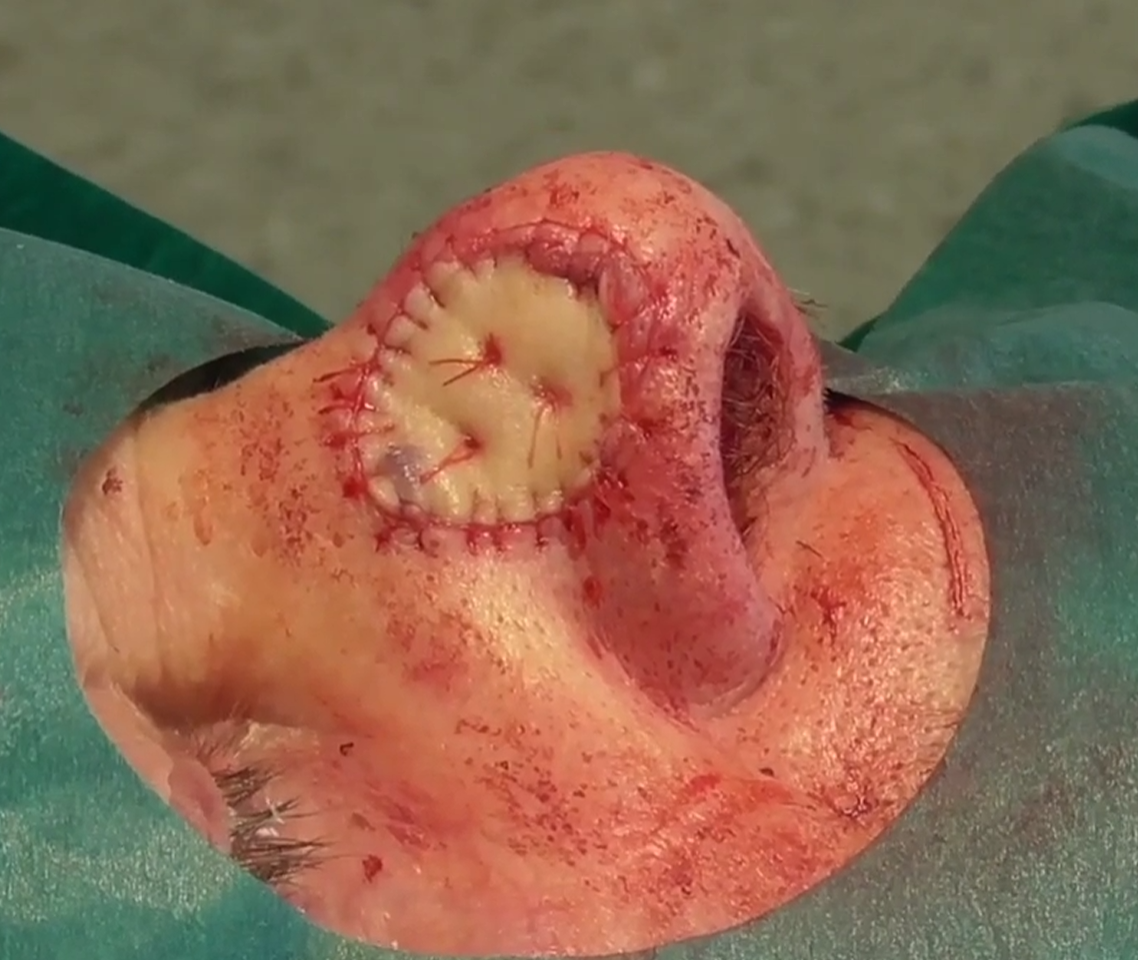 Close-up of a surgically altered human ear with visible stitches, swelling, and redness, possibly post-operation.
