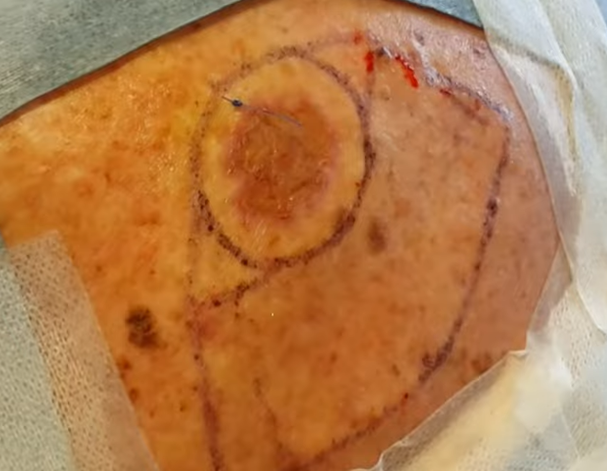 A breast implant with surface markings, placed under the skin during a surgical procedure.