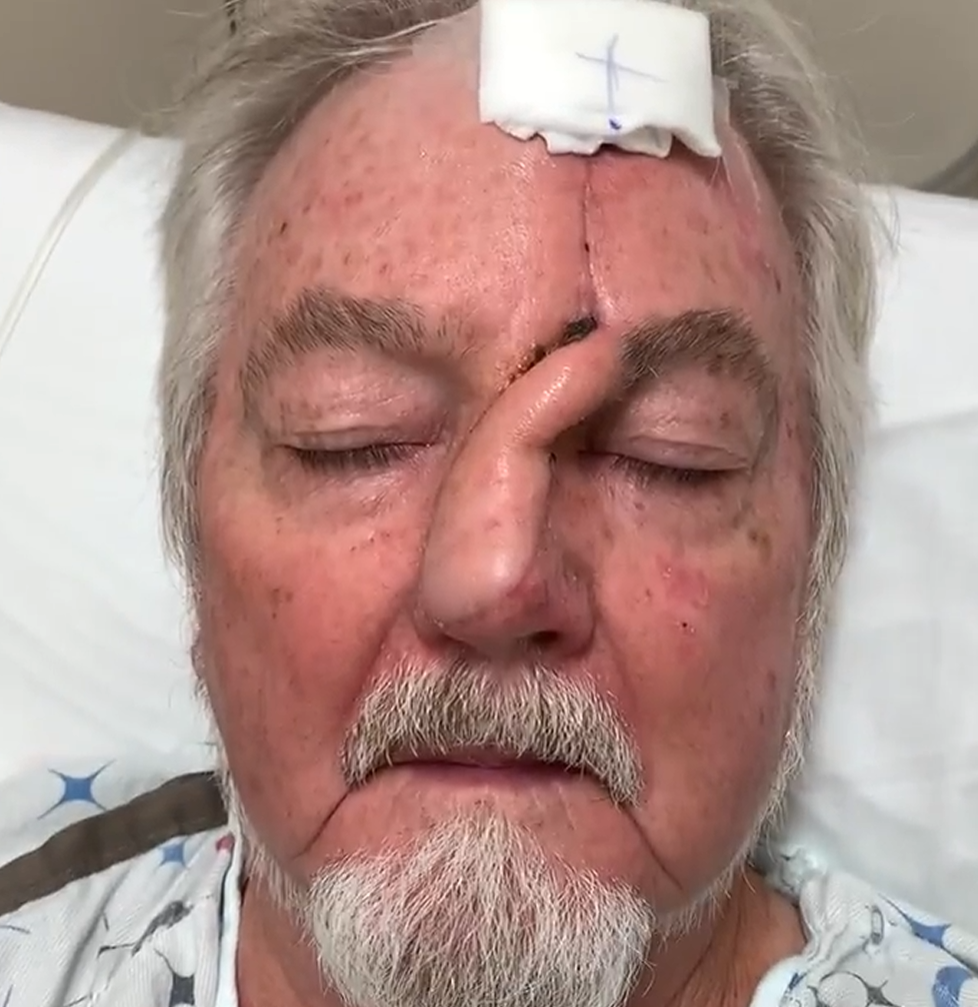 An elderly man with a bandage on his forehead, appearing to be in a hospital bed with closed eyes, with a tired facial expression.