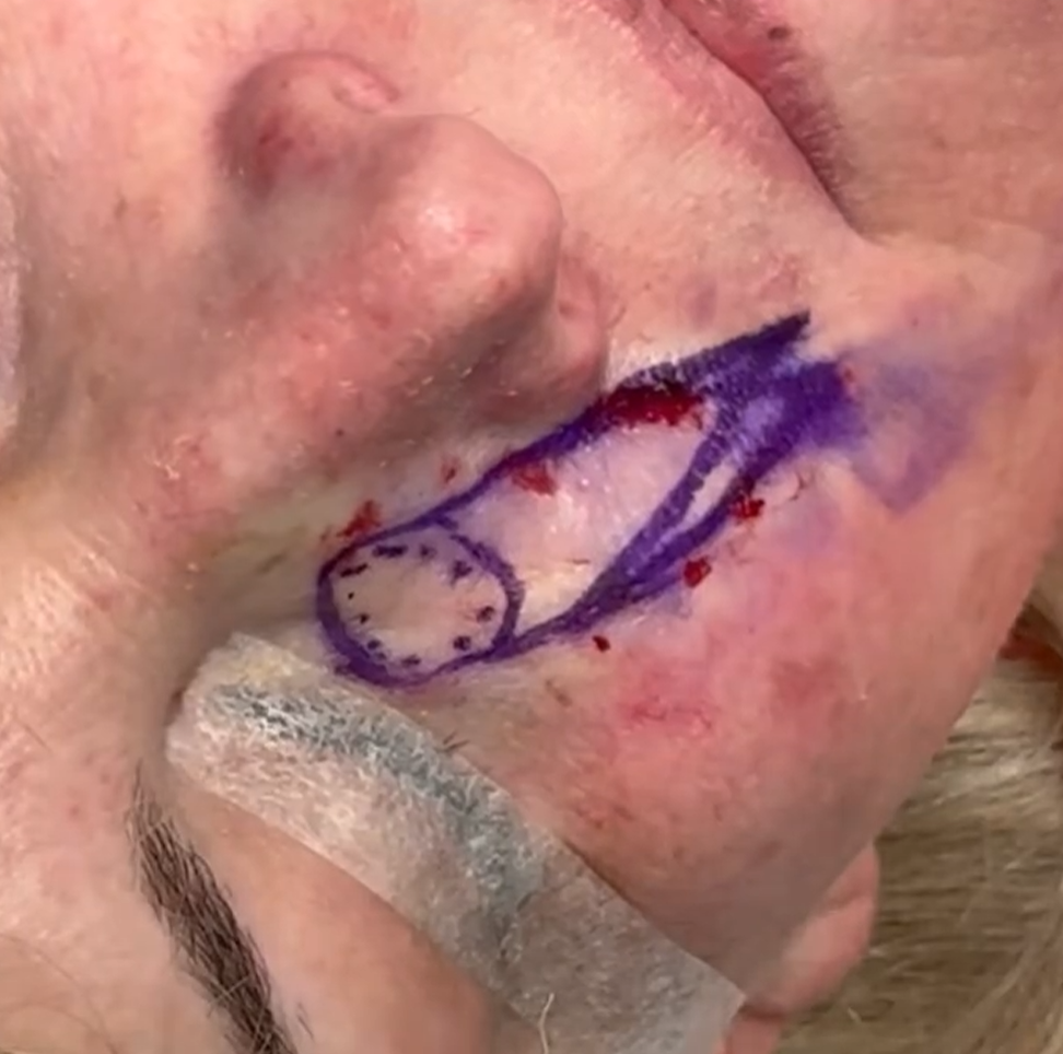 Close-up of a person's face with a surgical marking drawn near the lips, with some blood and a bandage on the chin.