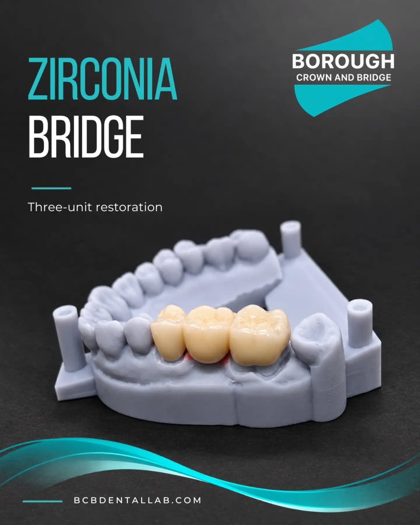 3-Unit Zirconia Bridge 🦷

A closer look at a recently completed three-unit zirconia bridge at BCB.

Carefully shaped and finished, with attention to occlusal anatomy, contours and aesthetics.

From digital design to the final restoration, every stag