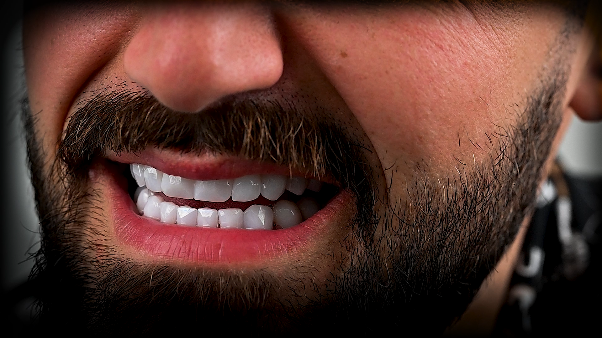 Diamond Crown and Diamond Veneers.png