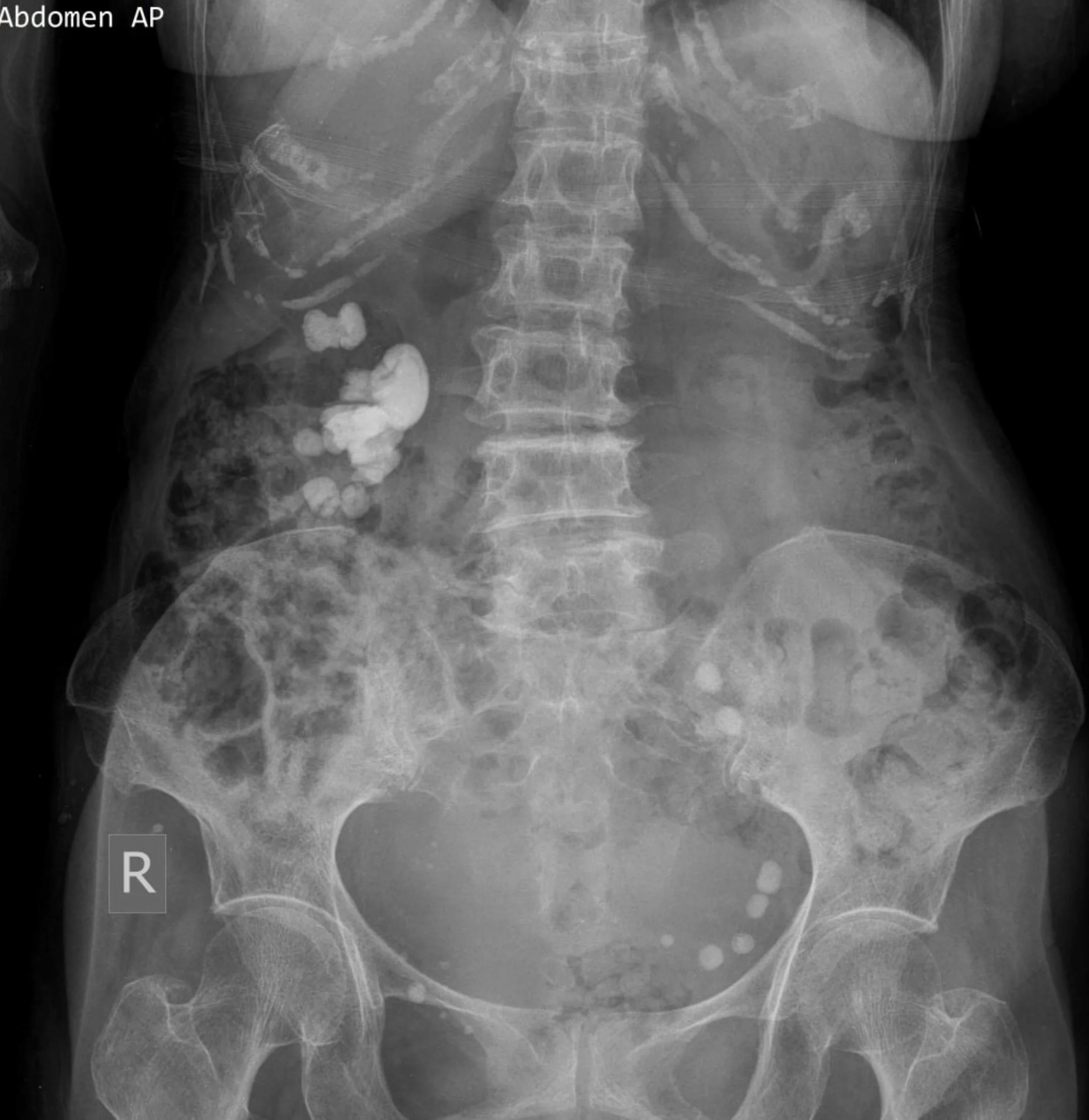 Raio X de abdômen mostrando coluna, pelve, vértebras, cólon e outros órgãos internos.