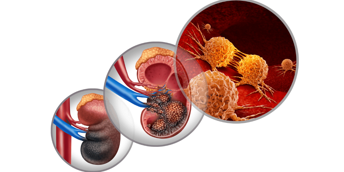 Ilustração médica mostrando células cancerígenas e órgãos, com foco na bexiga e nos rins.