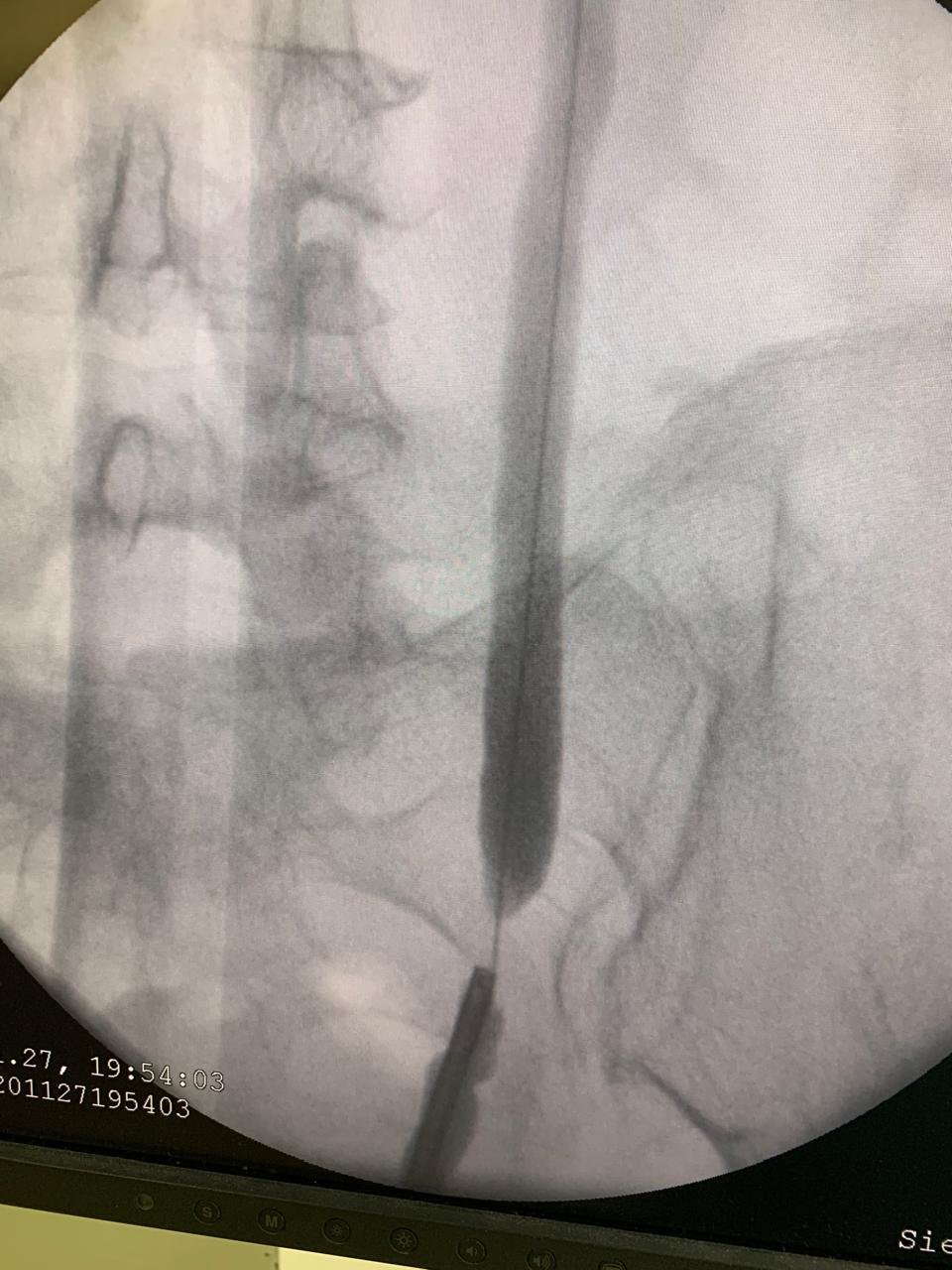 Imagem de uma radiografia mostrando a região lombar da coluna vertebral com um procedimento de injeção ou biópsia na vértebra com uma agulha.
