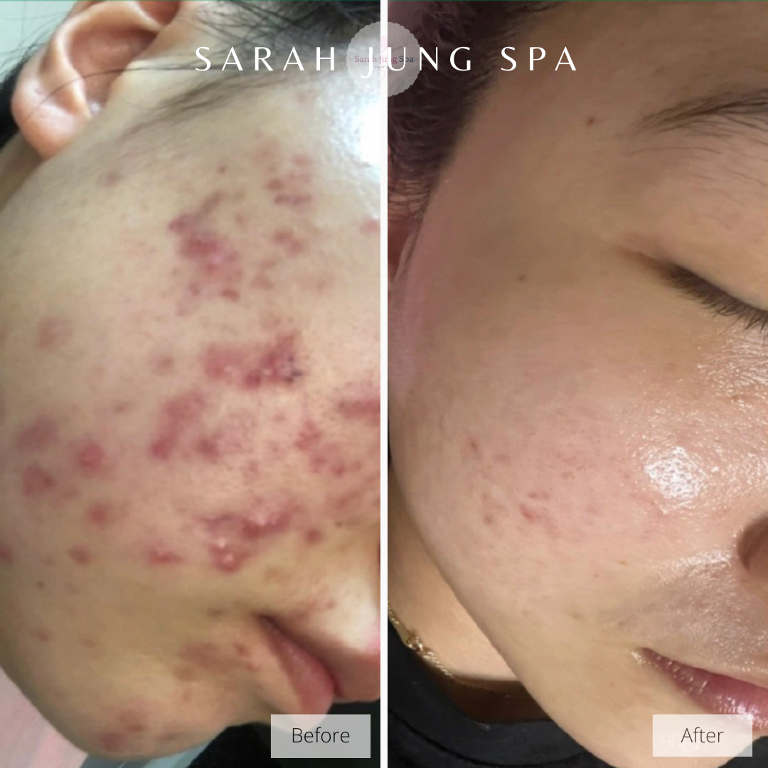Side-by-side comparison of a person's cheek before and after skincare treatment, showing improvement in acne and skin texture.