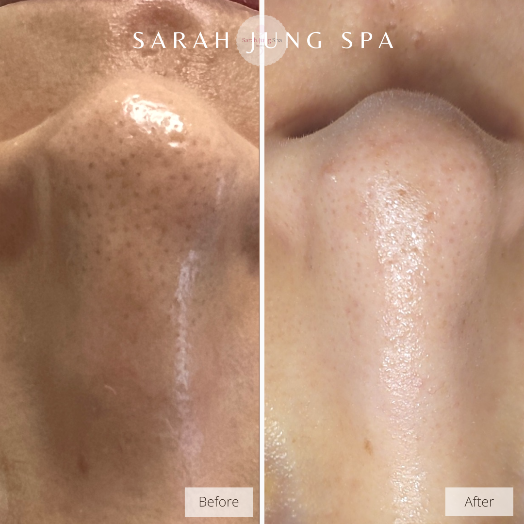 Nose Pore Special Care