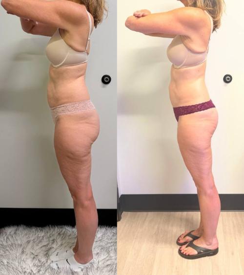 Side-by-side comparison of a woman before and after weight loss. In both images, she is standing in profile, wearing a bra and underwear, highlighting her change in body shape and size.