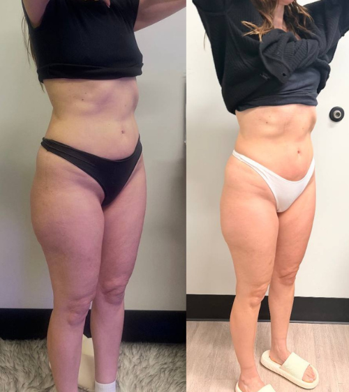 Comparison of a woman's lower body before and after weight loss, showing reduced body fat and a more toned appearance.