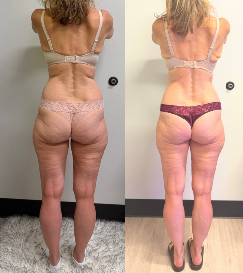 Comparison of a woman’s back and legs before and after body transformation, showing reduced cellulite and improved muscle tone.