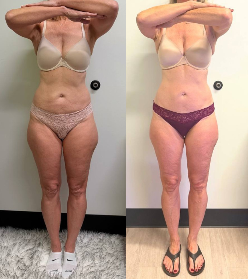 Side-by-side comparison of a woman before and after weight loss, wearing bras and underwear, in front of a plain wall.