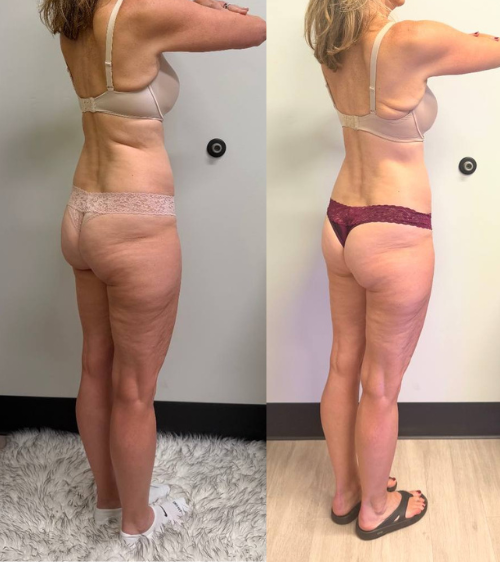 Side-by-side before and after photos of a woman showing weight loss and body transformation.
