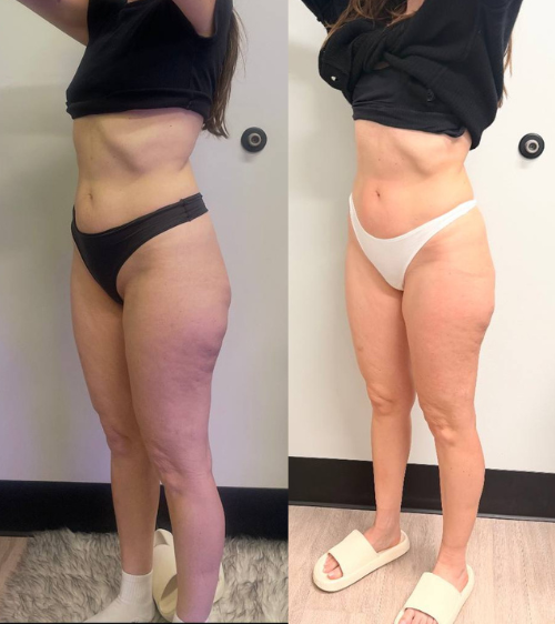Comparison of a woman's legs and waist before and after treatment showing reduction in cellulite and skin smoothness improvements.