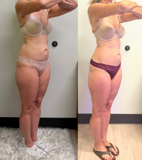 Comparison of a woman before and after a weight loss or body transformation, standing in similar pose in each photo.