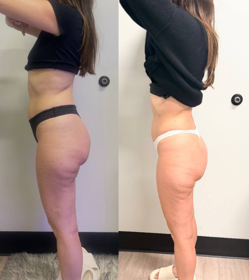 Side-by-side comparison of a woman before and after losing weight, showing reduced body fat and cellulite.