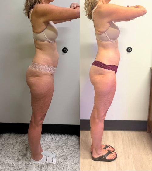 Side-by-side comparison of a woman before and after weight loss, showing reduced body fat and a more toned physique.