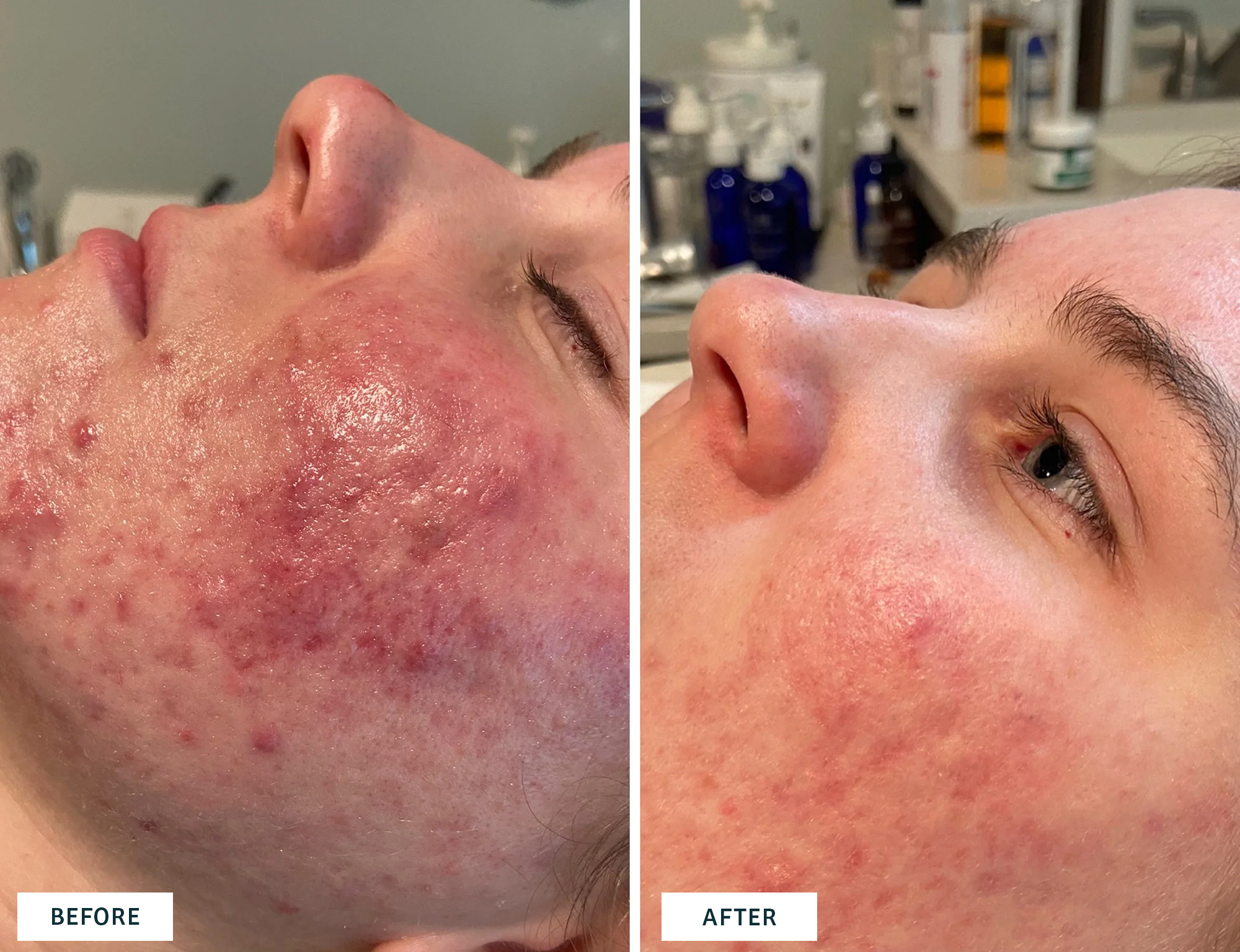 Omega Green Acne Clearing Facial