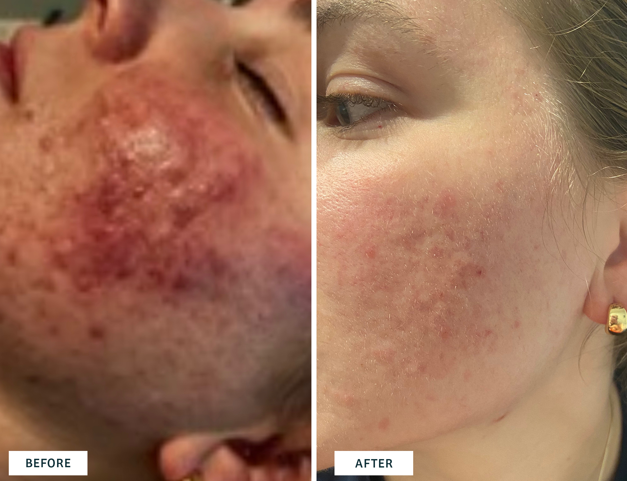 Omega Green Acne Clearing Facial