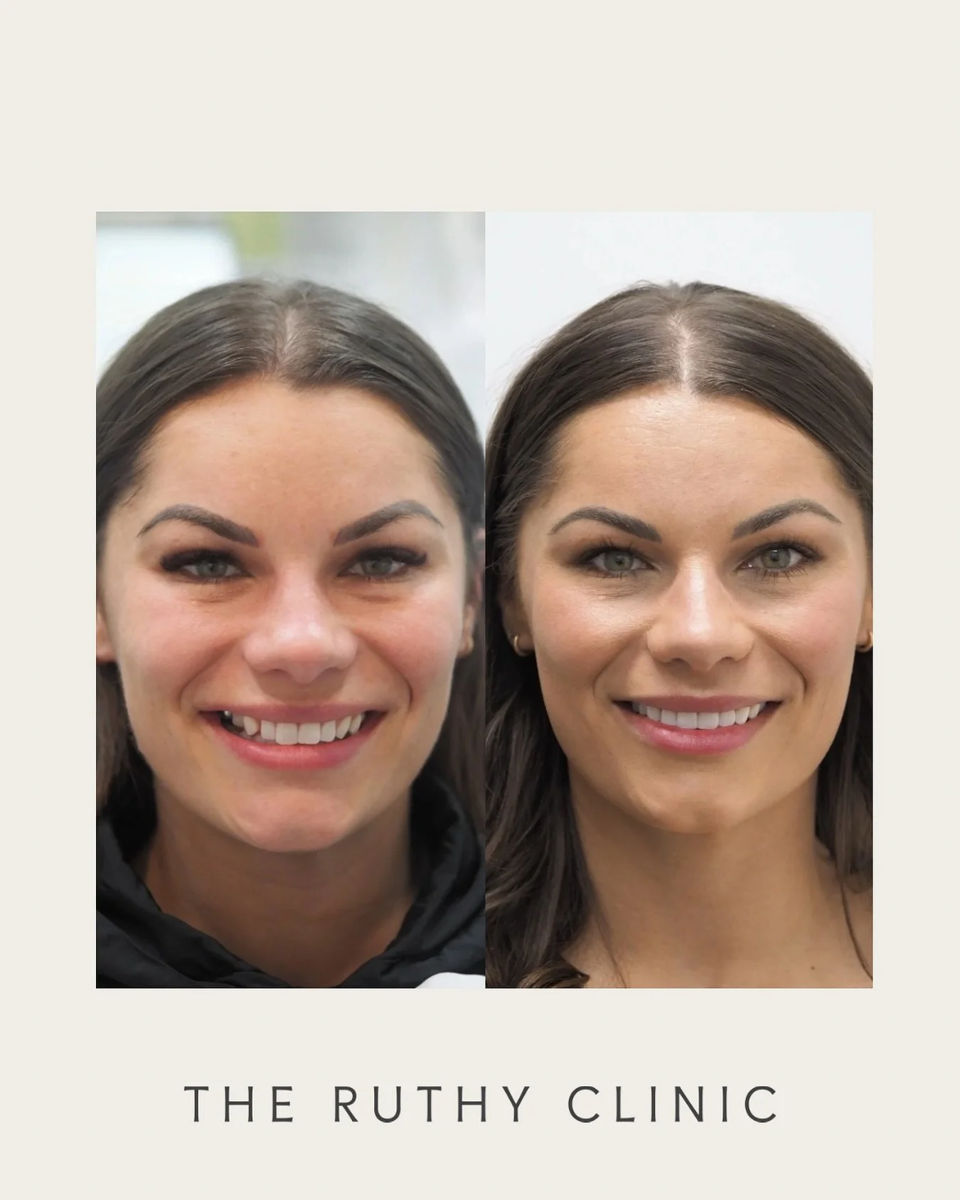 Primary treatment procedure: Composite Bonding and Bridge

The after image was taken approximately 1 week after the procedure.

At The Ruthy Clinic, your consultation is centred on your individual goals, concerns, and treatment options. Our registere