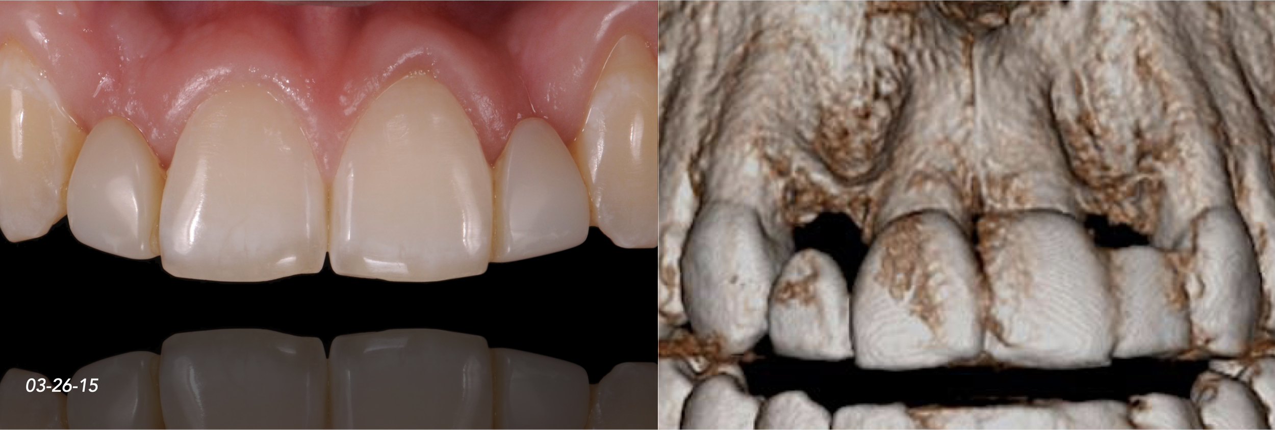 CASE 2.  CONGENITALLY MISSING LATERAL INCISORS