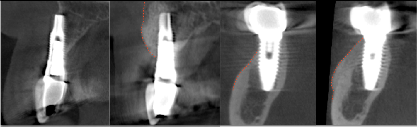 bone-graft-example.png