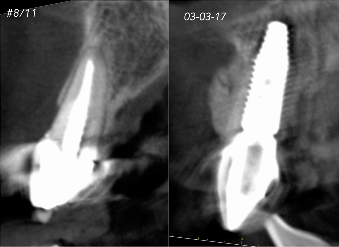 CASE 8.  IMMEDIATE IMPLANT AND SIMULTANEOUS S.M.A.R.T.® HORIZONTAL AUGMENTATION