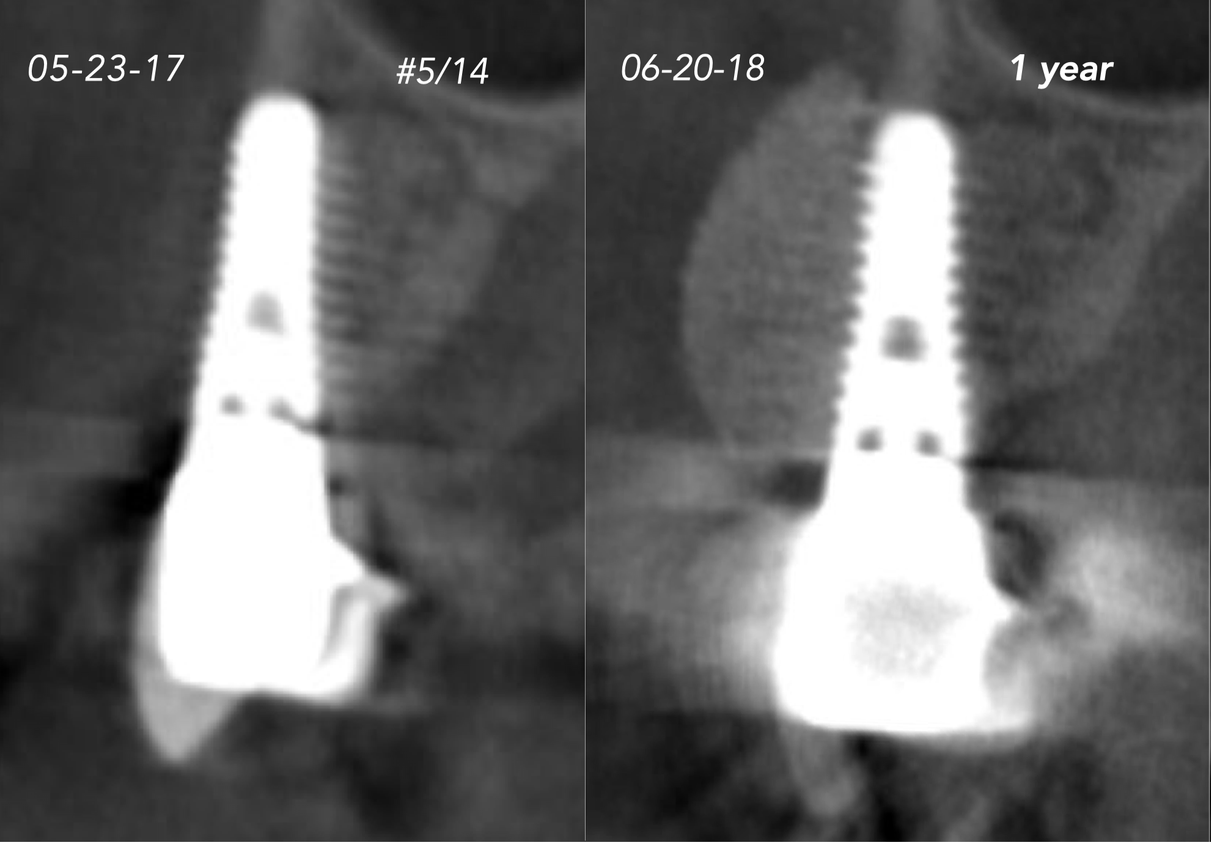 CASE 6.  IMPLANT BONE DEHISCENCE