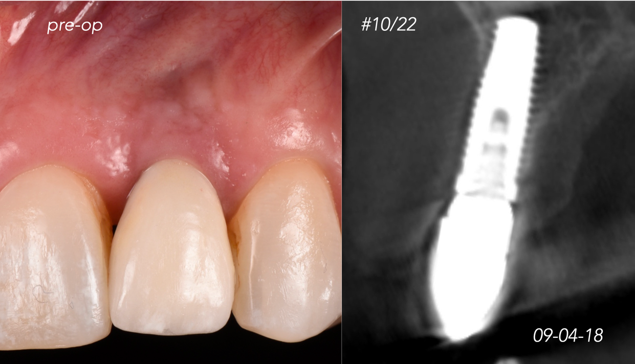 CASE 5.  IMPLANT BONE DEHISCENCE