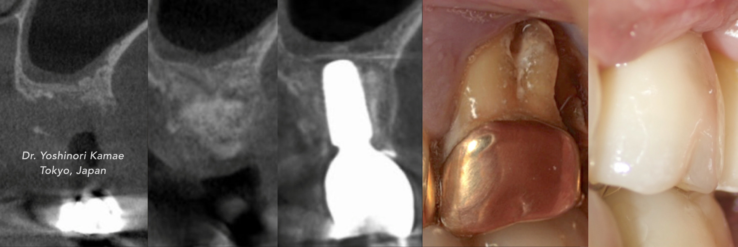 CASE 3.  VERTICAL AUGMENTATION