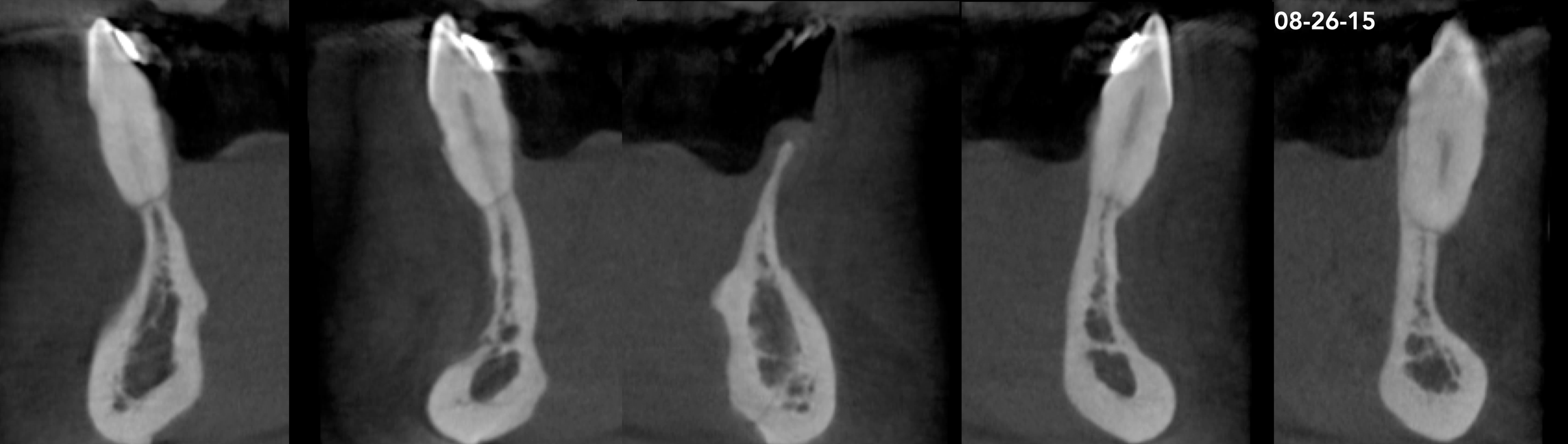 CASE 7.  KNIFE-EDGE RIDGE