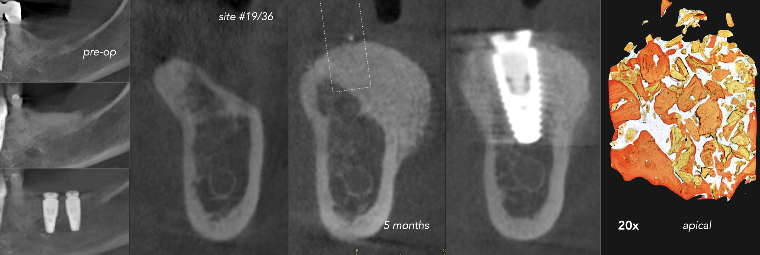 CASE 4.  VERTICAL AUGMENTATION