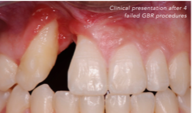 CASE 1.  COMPLEX IATROGENIC DEFECT