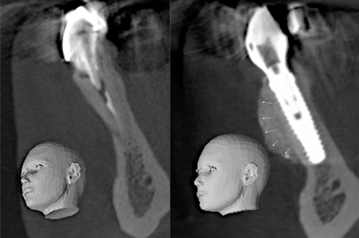 CASE 9.  IMMEDIATE IMPLANT AND SIMULTANEOUS S.M.A.R.T.® HORIZONTAL AUGMENTATION