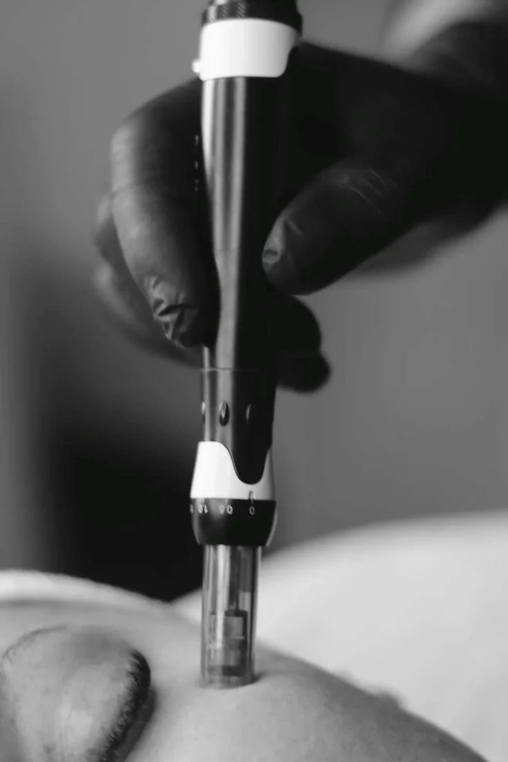 Embrace Your Skin: How Microneedling Can Transform Stretch Marks at The Hideout