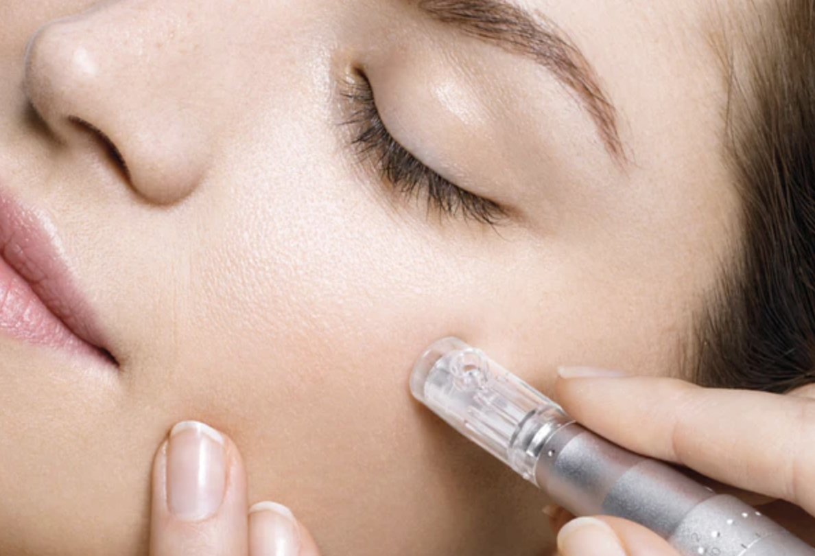 The Ultimate Guide to Skin Quality: Why Microneedling is Your New Best Friend