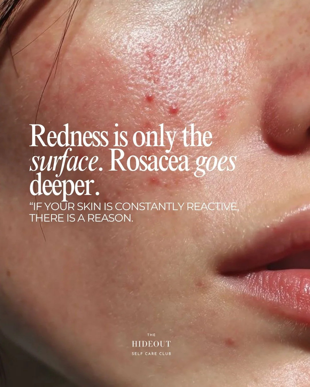 April is Rosacea Awareness Month.

Rosacea is not something you &ldquo;fix&rdquo; overnight.
It is something you learn to understand, support and manage correctly.

Most people are over-treating their skin.
Too many actives. Too much heat. Too much g