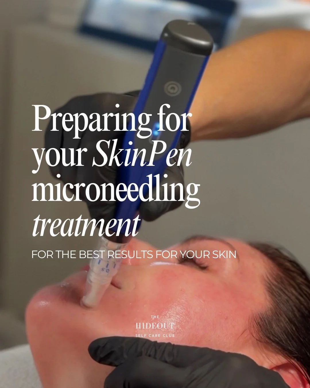 This is the treatment that changes your skin.

Not instantly. Not superficially.
But in a way that actually lasts.

SkinPen works where it matters, stimulating collagen, strengthening the skin, and creating that glow people can&rsquo;t quite put thei